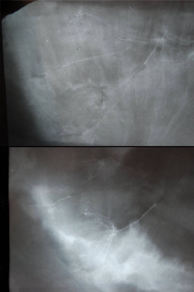 Hapalocrinus frechi, Bundenbach